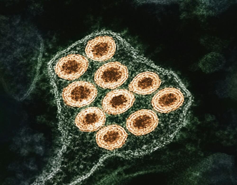Can Epstein-Barr Virus Trigger Long COVID or Chronic Fatigue Syndrome?