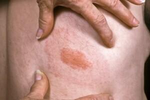 Chronic Lyme Symptoms Explained