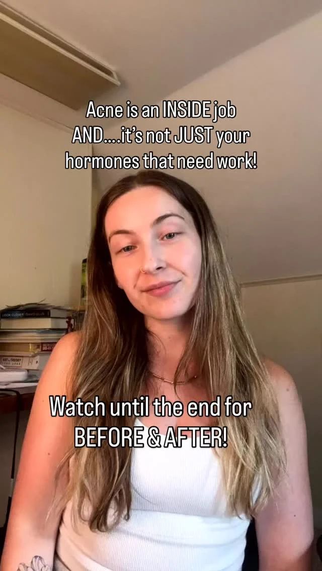 ✨ Sometimes it’s not even your hormones. Say What?!

I have seen countless patients that actually have balanced hormones and have acne. And, when I say “balanced”, I actually mean from a Naturopathic Doctor perspective where we test on the right day and time and do specialty type testing from @dutchtest 
 
Acne can be driven by chronic inflammation, gut dysbiosis, infections, food allergies/sensitivities, mold illness, stress and nervous system dysregulation.⁣
 
Acne isn’t just a skin issue. It’s a signal. 💡

Most of our patients come to us after trying every topical, every supplement, every “hormonal” fix—and still breaking out.
⁣
This patient’s story is one of many: years of frustration, finally resolved when we looked beneath the surface.
⁣
We identify the true root causes so your body can actually heal—and your skin reflects that. 

⭐️ Every patient receives a very specifically tailed health plan since have patient has a different root cause. 
⁣
If you’ve been told your labs are “normal,” that acne is “just hormonal,” please know there is another way. 
⁣
🌀 We specialize in acne that hasn’t responded to conventional care. And we’d love to help you too.
⁣
📩 Comment “ACNE” or tap the link in bio to book a free 10-minute consult to see if we’re the right fit.
 
XO, 
Dr. Sue
